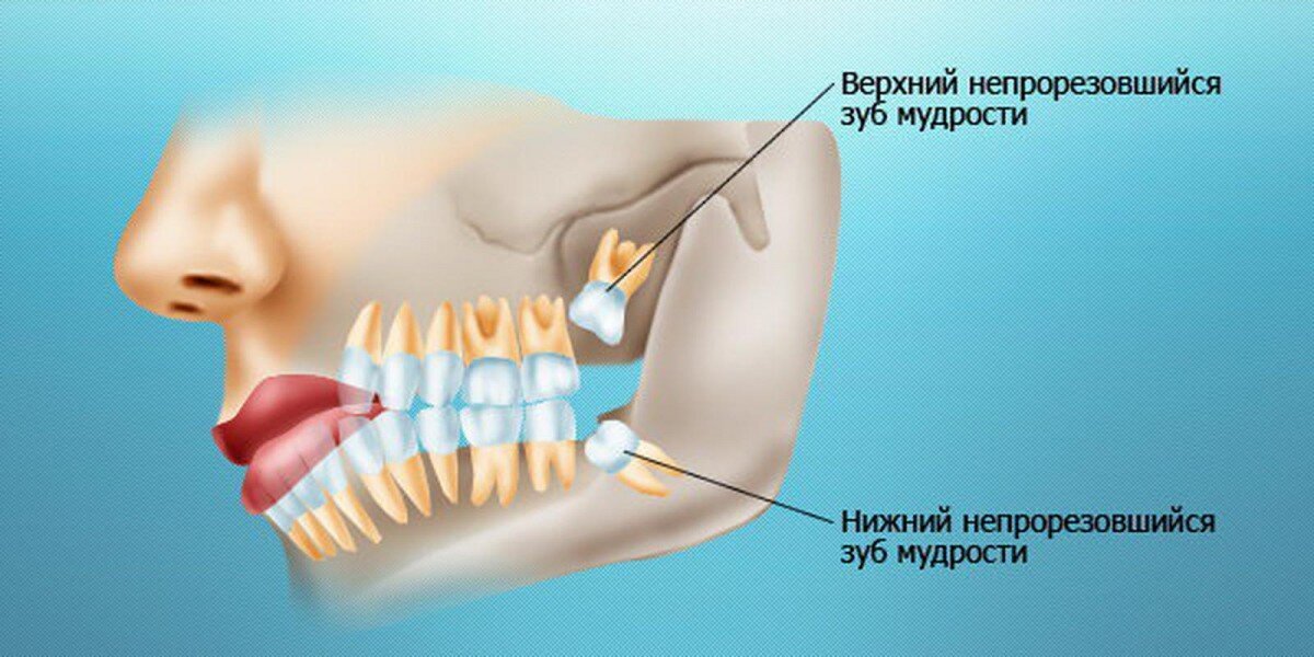 Прорезается зуб мудрости