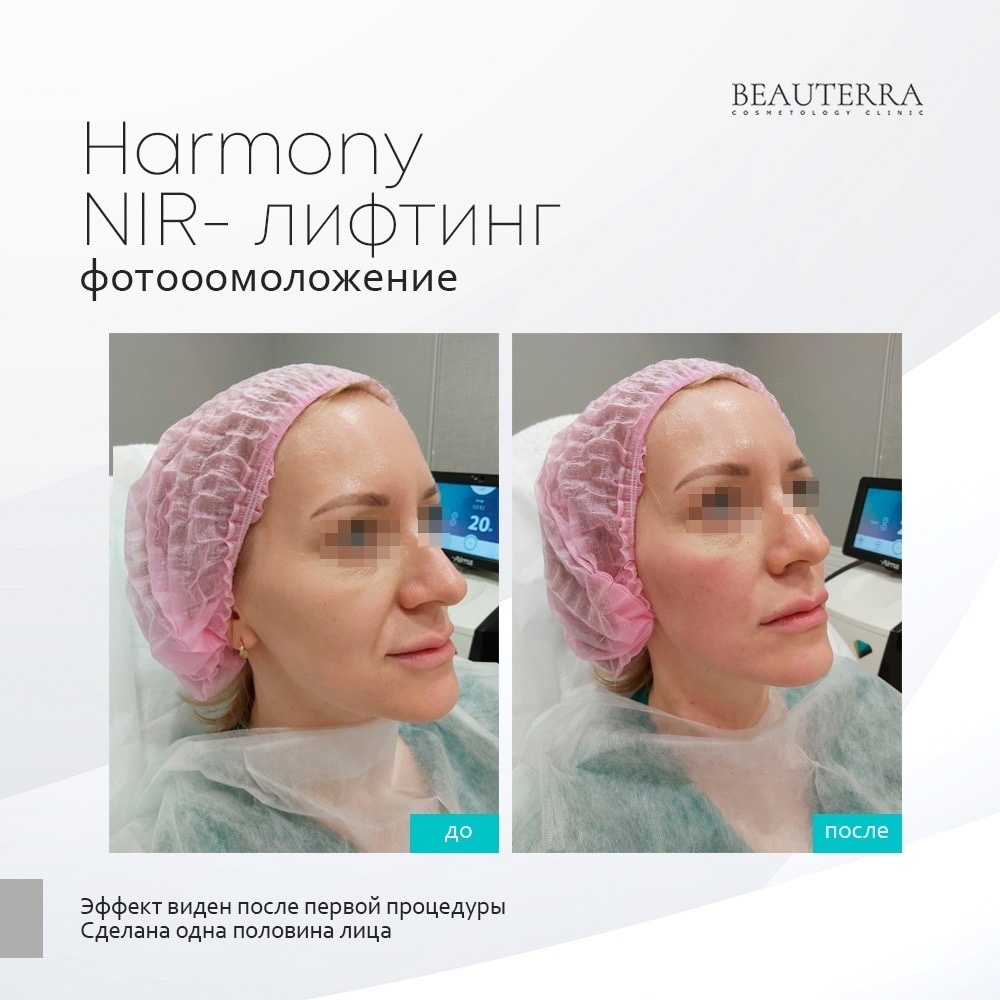 Harmony - NIR фотоомоложение в смарт-клинике Beauterra