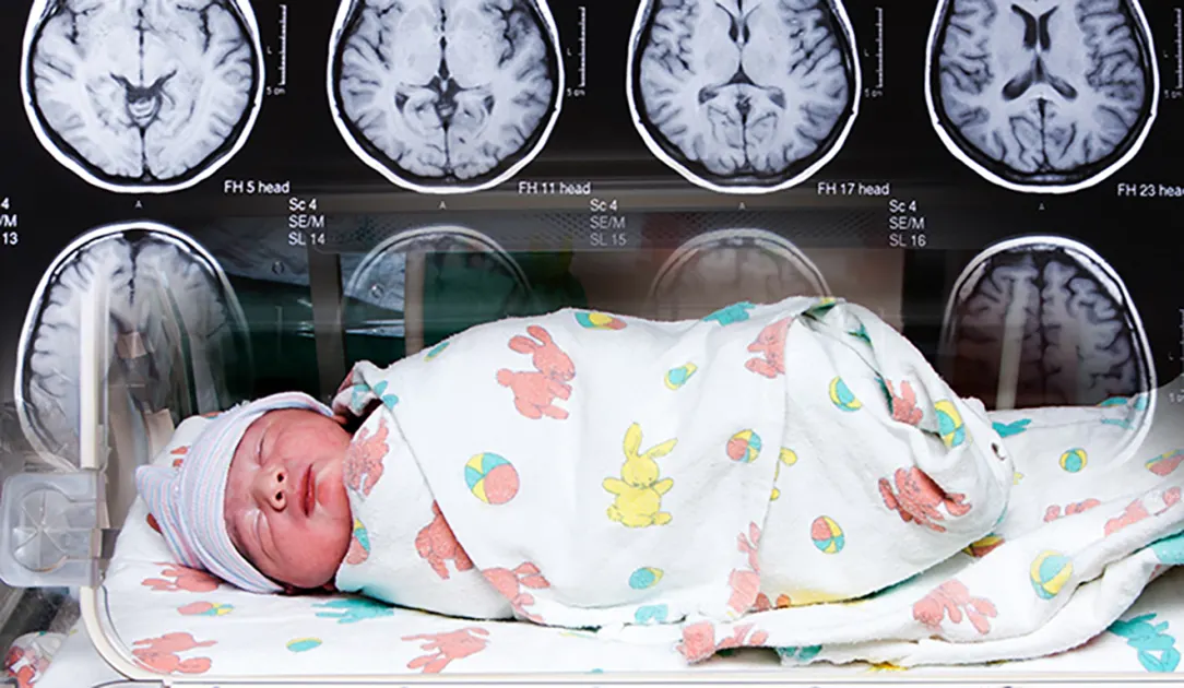 Головной мозг недоношенных. Мозг недоношенного ребенка. Незрелый головной мозг у недоношенных. Головной мозг у недоношенного новорожденного.