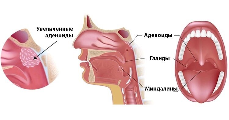 Острый и хронический тонзиллит у детей