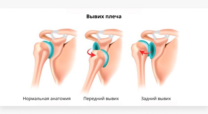 Боль в плече - причины, симптомы, диагностика, лечение заболеваний плечевого сустава