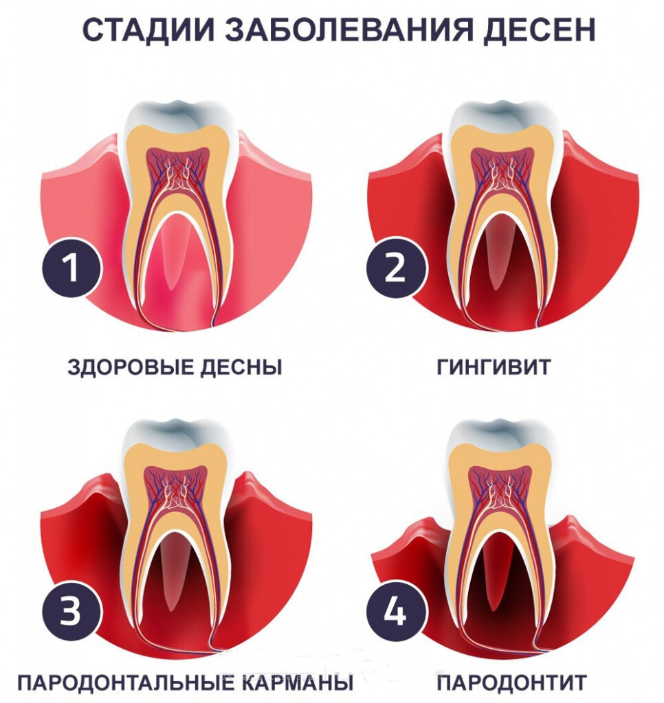 Как выглядит здоровая десна?