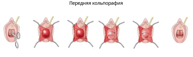 Интимная пластика. Омоложение интимной зоны с помощью хирургии | Pérez de la Romana