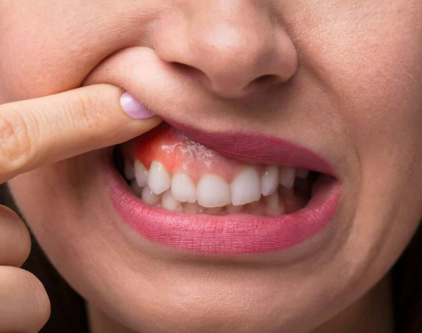 Гнойный абсцесс зуба: фото, лечение абсцесса десны после удаления зуба