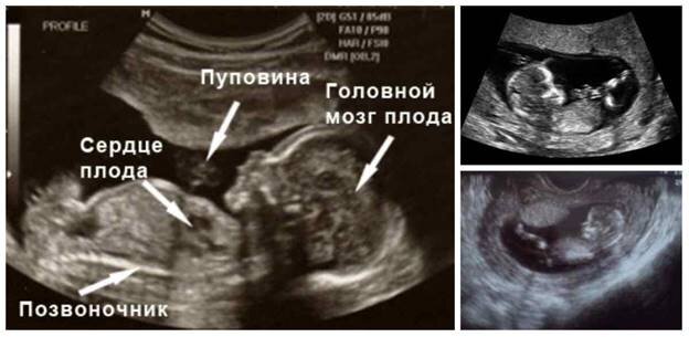 УЗИ I триместра беременности (до 14 недель) + 4D-визуализация