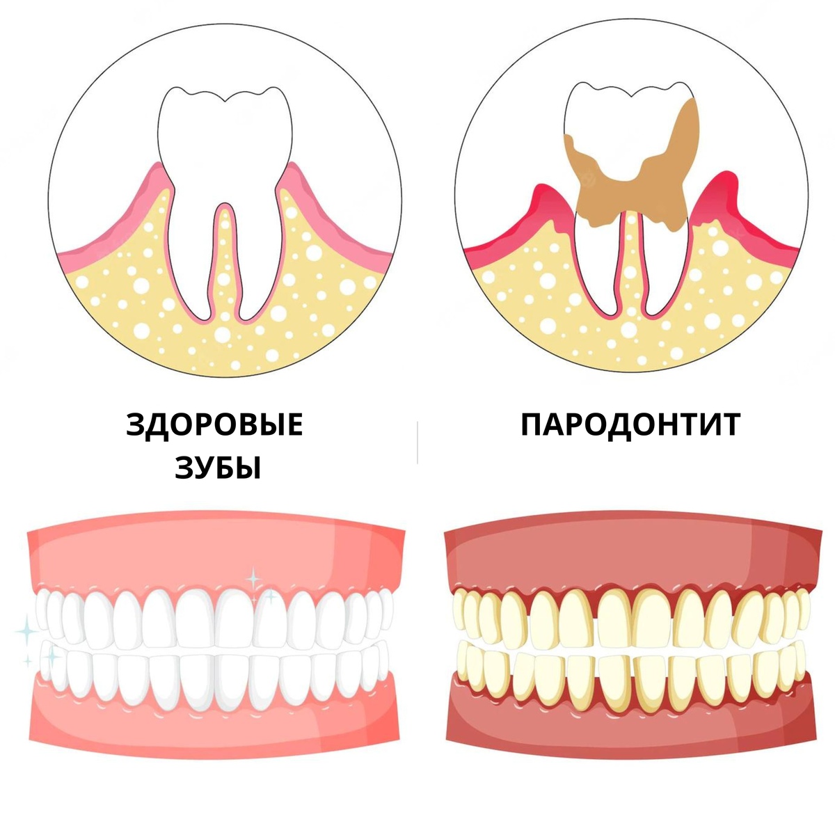 Пародонтит зуба