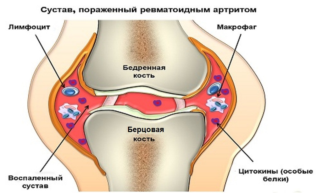 Боль в суставах кистей рук