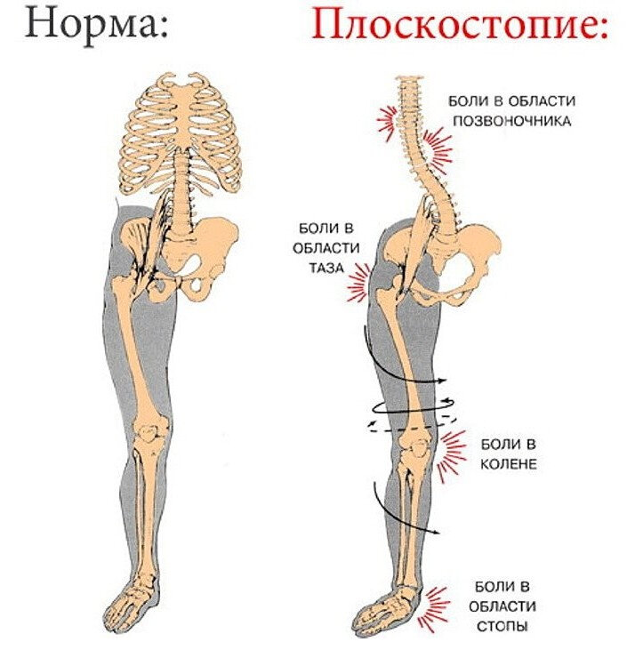 Дисфункция тазового дна