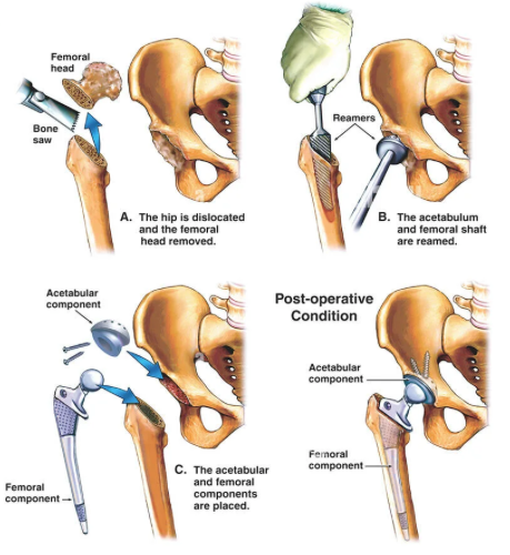 Очень схематичное и упрощенное изображение этапов протезирования тазобедренного сустава. Здесь вообще не показаны мягкие ткани ...
