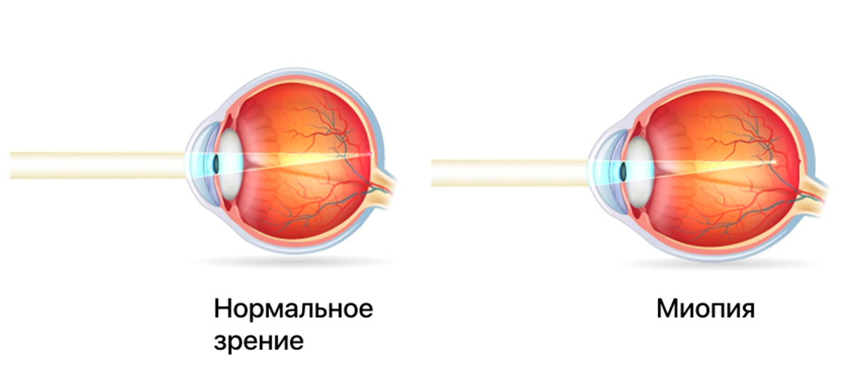 Изображение на сетчатке четкое. Форма глазного яблока при миопии. Миопия гиперметропия астигматизм. Изменение формы глазного яблока при близорукости. Нормальное зрение и миопия.