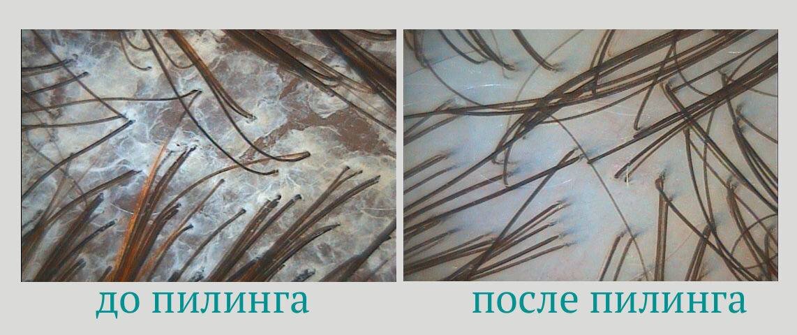 Фото под микроскопом, до и после пилинга