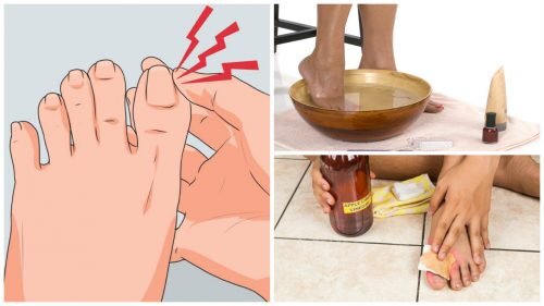 Знаете ли вы, что имбирь может пригодиться для лечения вросших ногтей?