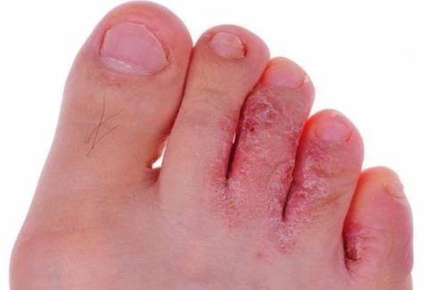  Кератомикоз кожи