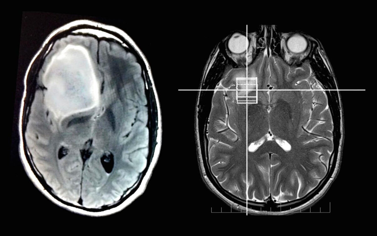 Объемное образование головного мозга диагностика