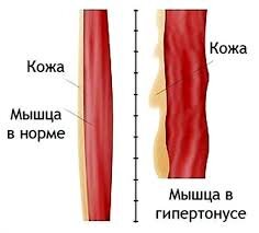 Гипертонус  мышц