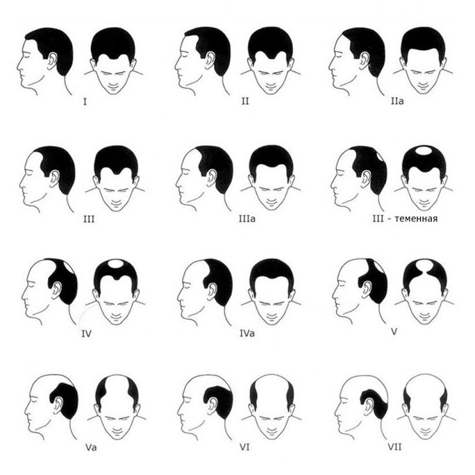 Степени облысения по Норвуду