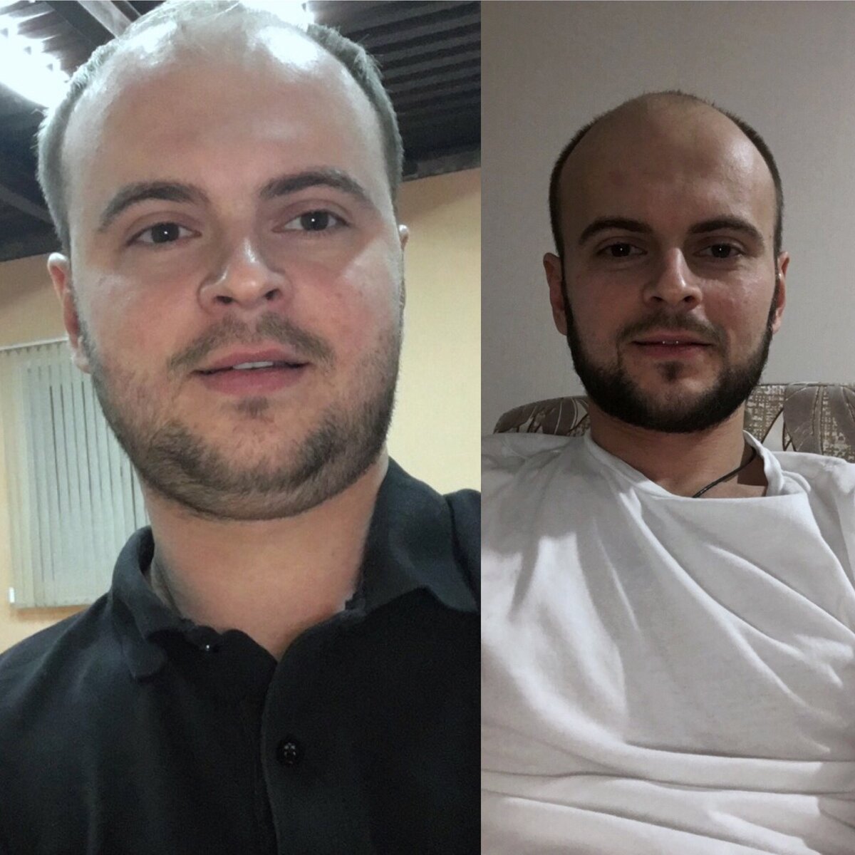 Я до (слева 75 кг.) и после (справа 63 кг.). Смотри на щёки, подбородок. Справа с более длинной бородой даже не настолько опухшим выгляжу.