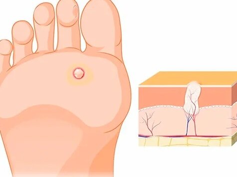 Подошвенная бородавка (шипица): причины и методы лечения