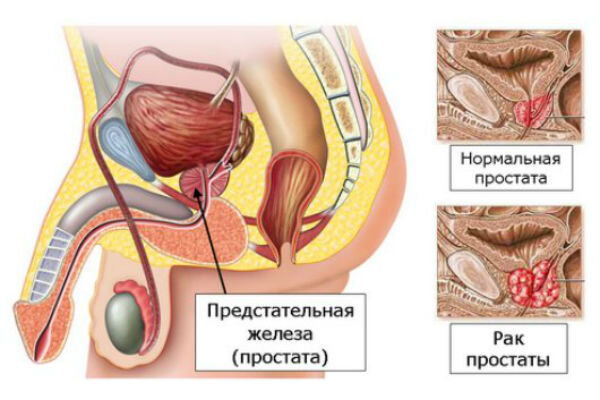 Аденома предстательной железы.