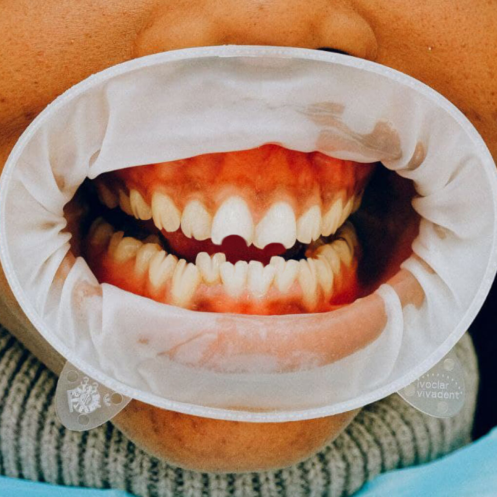 болезнь "зубы Гентчинсона"