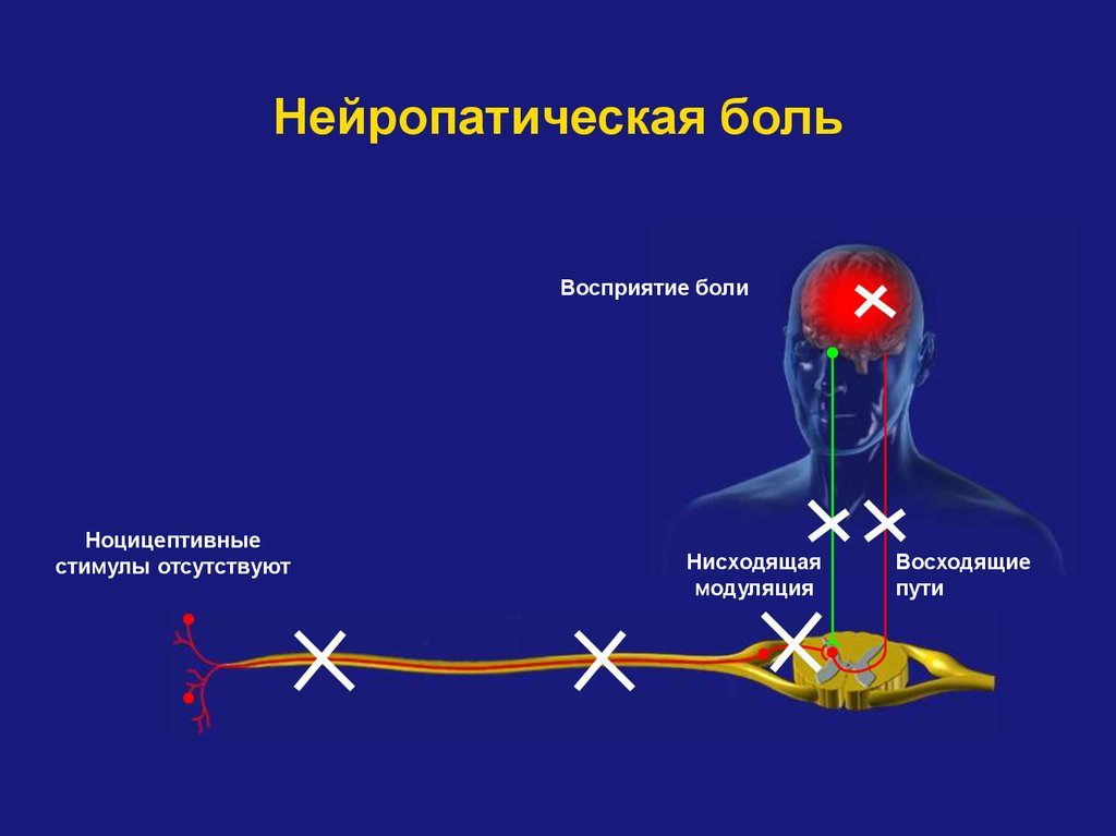 Схема фус восприятия боли