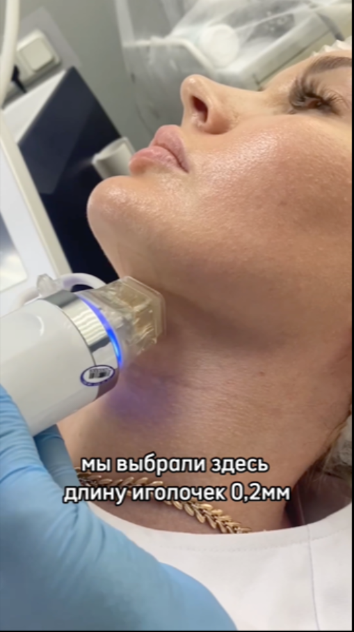 Игольчатый РФ-лифтинг. Подтяжка лица без боли и решение еще 11 проблем с кожей на лице и на теле. Рассказываем как это работает