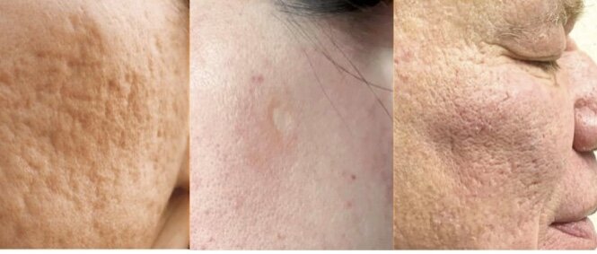 Рубцы до и после