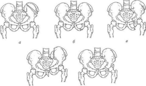  Перелом костей таза.