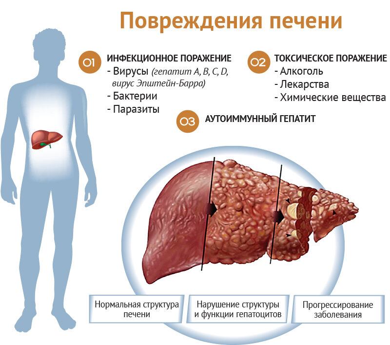 Признаки увеличенной печени. Токсическое поражение печени.