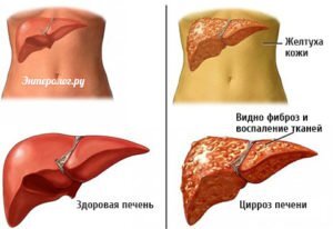 Что такое цирроз печени