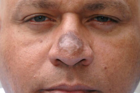  Твердое уплотнение после обморожения носа