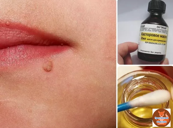 Лечим бородавки касторовым маслом