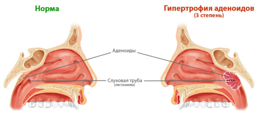 Увеличенные миндалины без температуры - о чем говорит симптом?