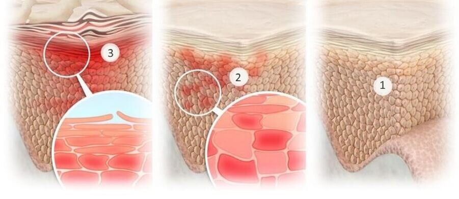 1. Здоровая кожа 2. Микровоспаление 3. Воспаление (эритема)
