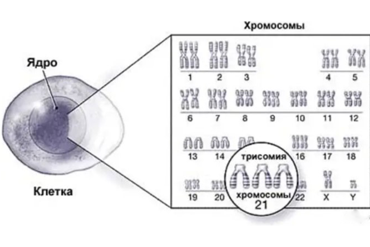 Строение клетки при наличии синдрома Дауна