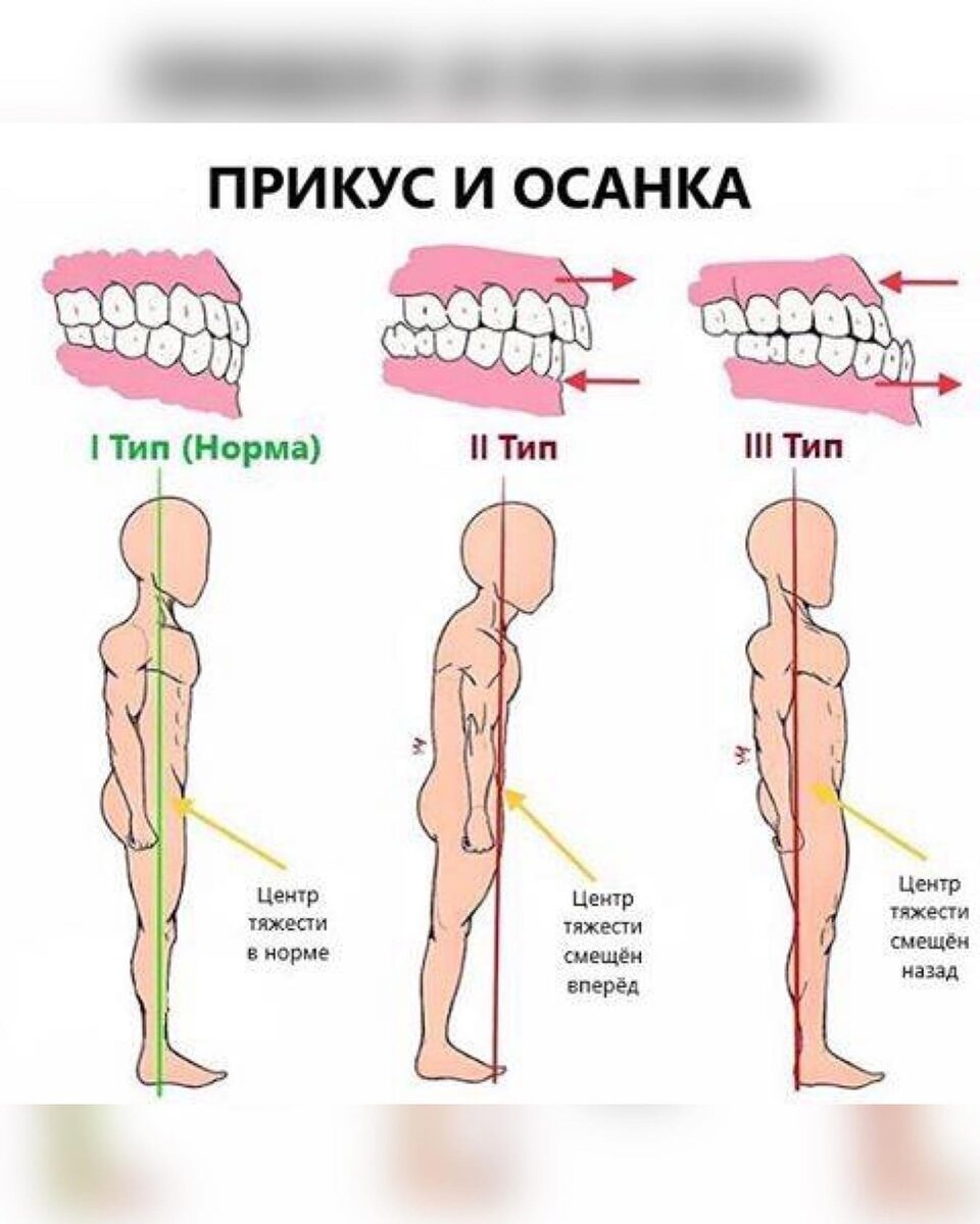 Дистальный прикус и осанка