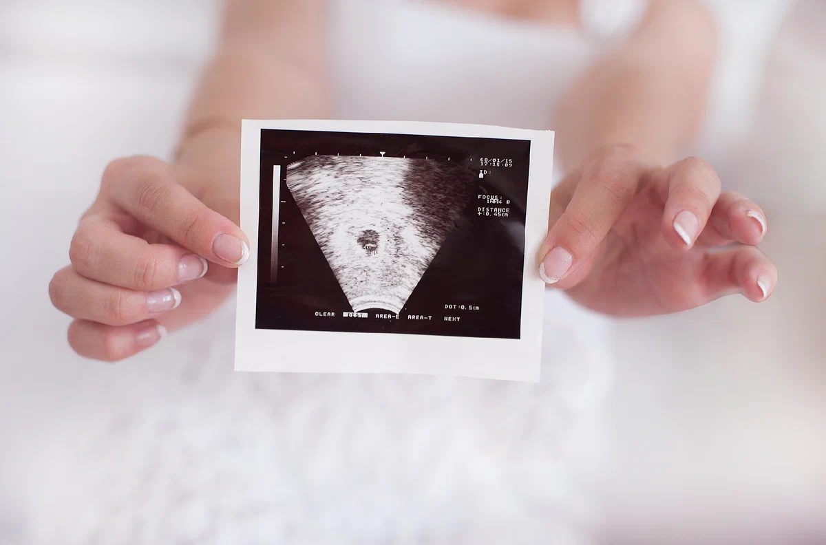 Беременность узи недели беременности видео. Снимок УЗИ на беременность 1 ребенок. Снимок УЗИ первый скрининг. 1 Триместр беременности снимки УЗИ.