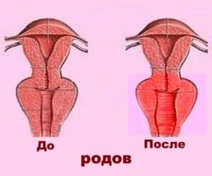 Опущение стенок влагалища: причины и лечение (коррекция)