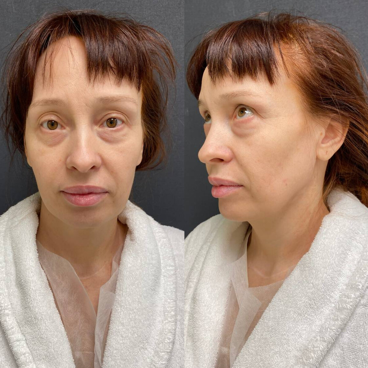 ДО комплексного омоложения 