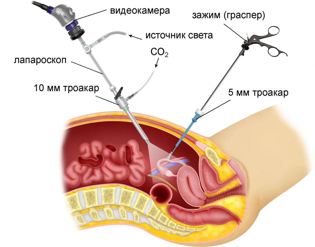 Операция удаления МИОМЫ МАТКИ - открытая, эндоскопическая и  лапароскопическая миомэктомия | Mednavigator.ru | Дзен