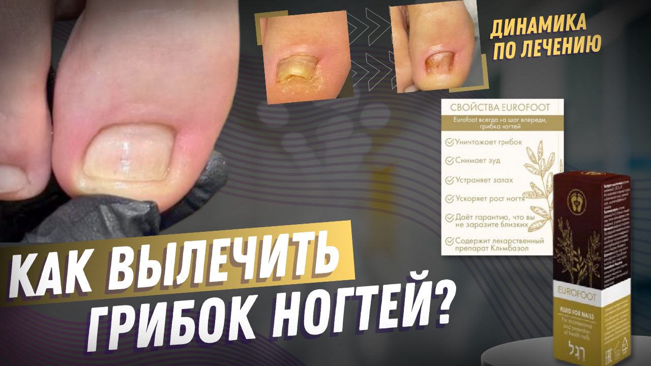 Как лечить грибок ногтей - Coolaser Clinic