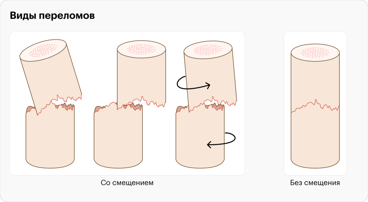 Скорая помощь ребенку после падения: удар головой (ЧМТ)