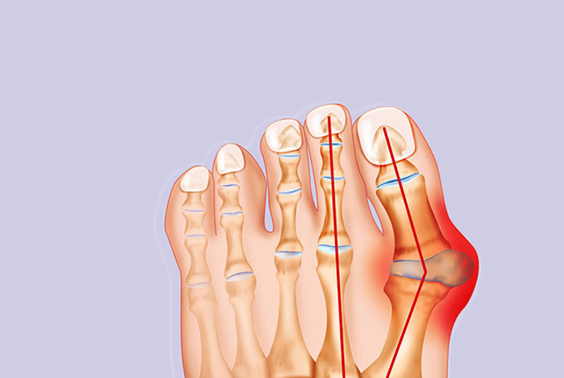 Как лечить вальгус. Бурсит вальгусной косточки.