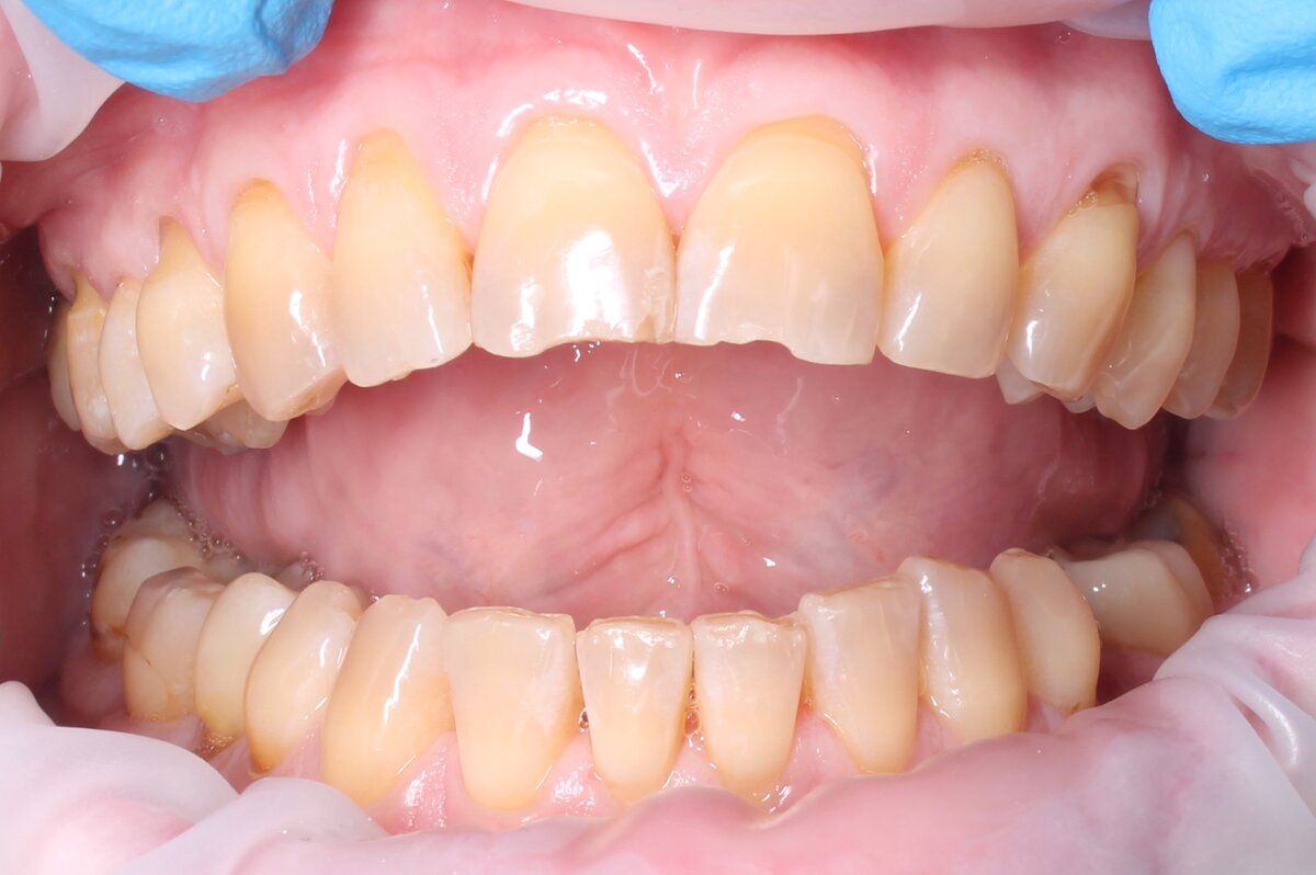 Невооруженным глазом видны рецесси десны (оголение корней). 