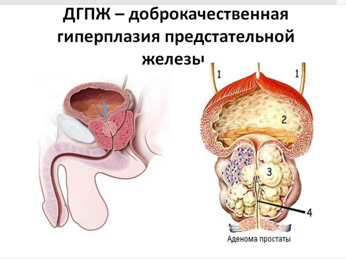 Аденома предстательной железы и ДГПЖ