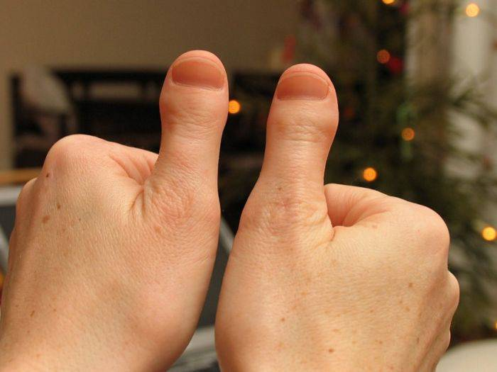 Пальцы становятся толще. Широкие большие пальцы. Короткий большой палец на руке. Широкие большиеп пальцы.