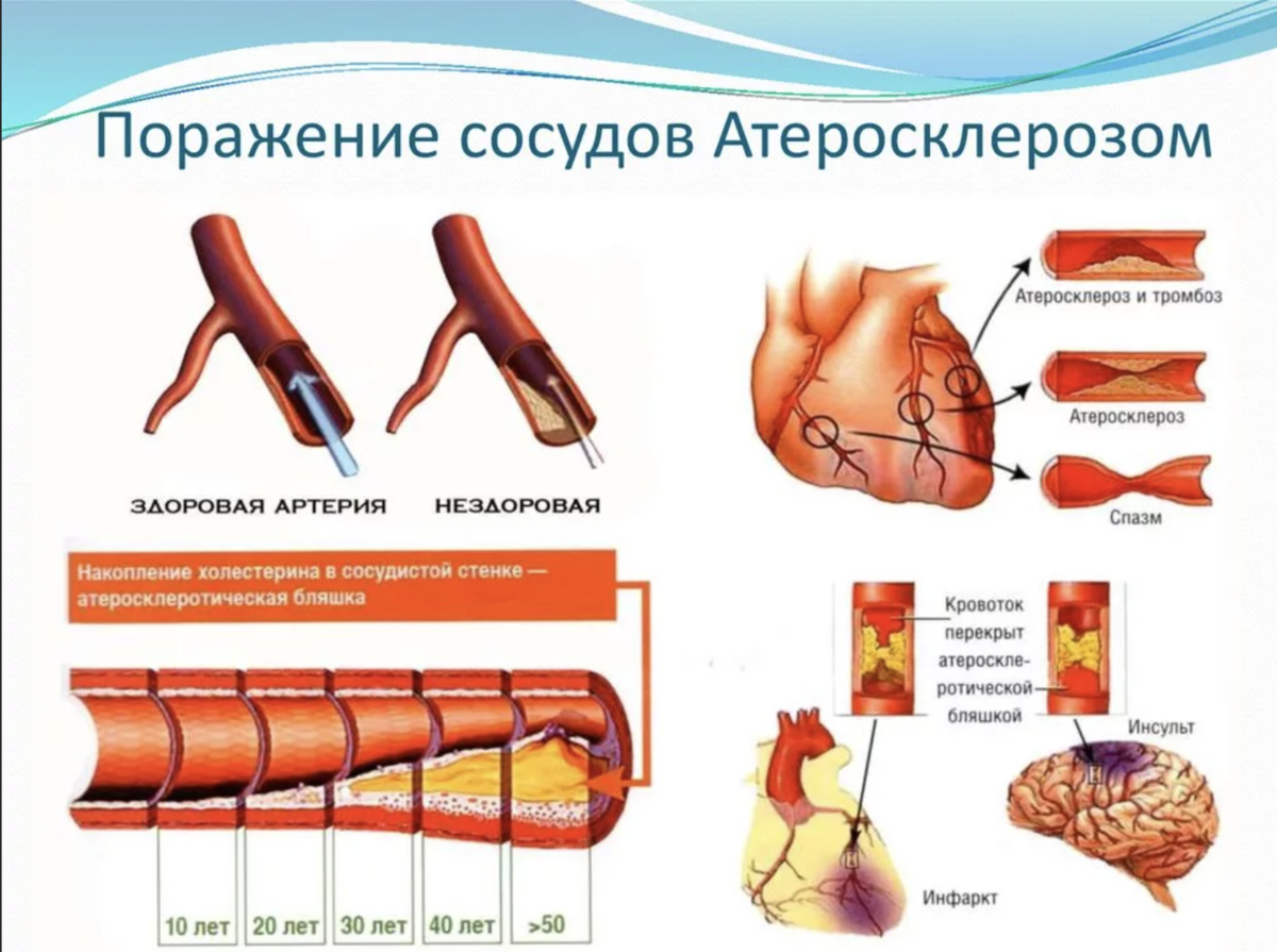 Атеросклеротическая сердца. Атеросклероз сосудов показатели. Влияние холестерина на сосуды. Влияние высокого уровня холестерина. Поражение сосудов атеросклерозом.