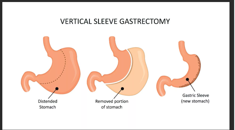 операция по уменьшению желудка
