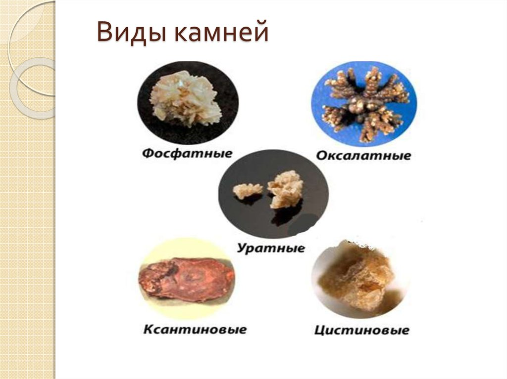 Камни в почках картинки