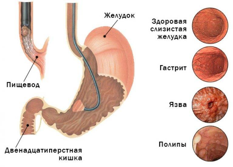 Сколько нельзя есть и пить до фгдс